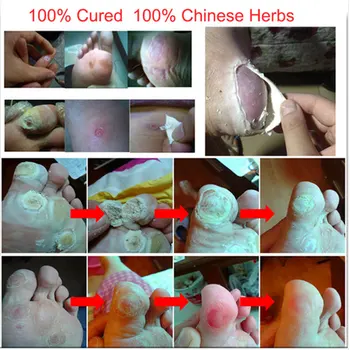 Tratament Medicina Chineză Picior De Porumb Îndepărtarea Verucilor Plantare Pomada De Verruga Picior De Îngrijire Medicală Ipsos Unguent De Îndepărtare A Verucilor
